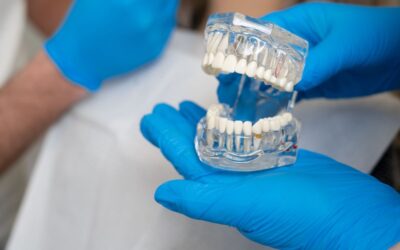 La durata degli impianti dentali e come prendersene cura