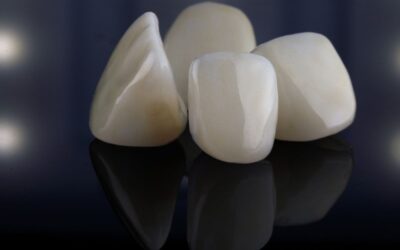 Faccette dentali vs. corone e capsule: quali differenze?